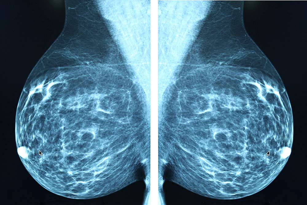 Breast imaging in Fort Myers Florida