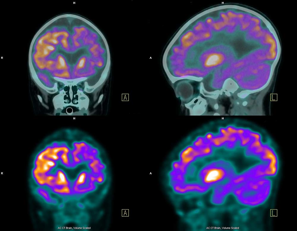 Brain FDG PET at Florida Radiology Consultants