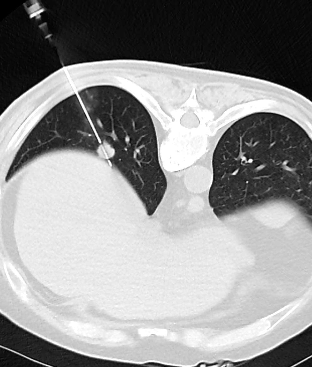 CT Guided Lung Biopsy