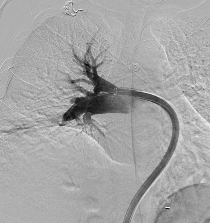 DVT & Pulmonary Embolism Treatment