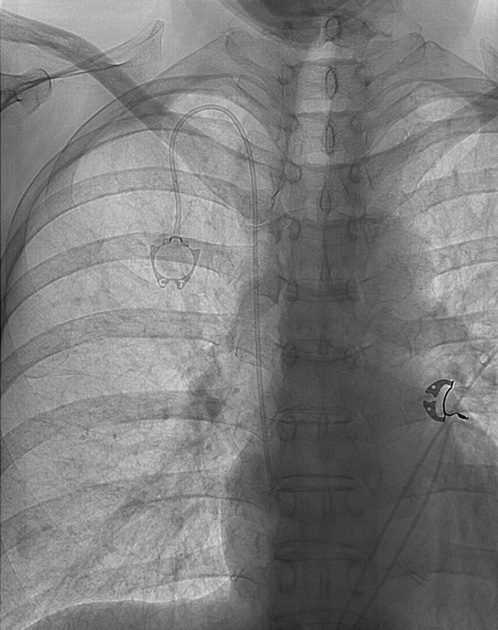 port placement interventional radiology catheter placement and supportive care at florida radiology consultants