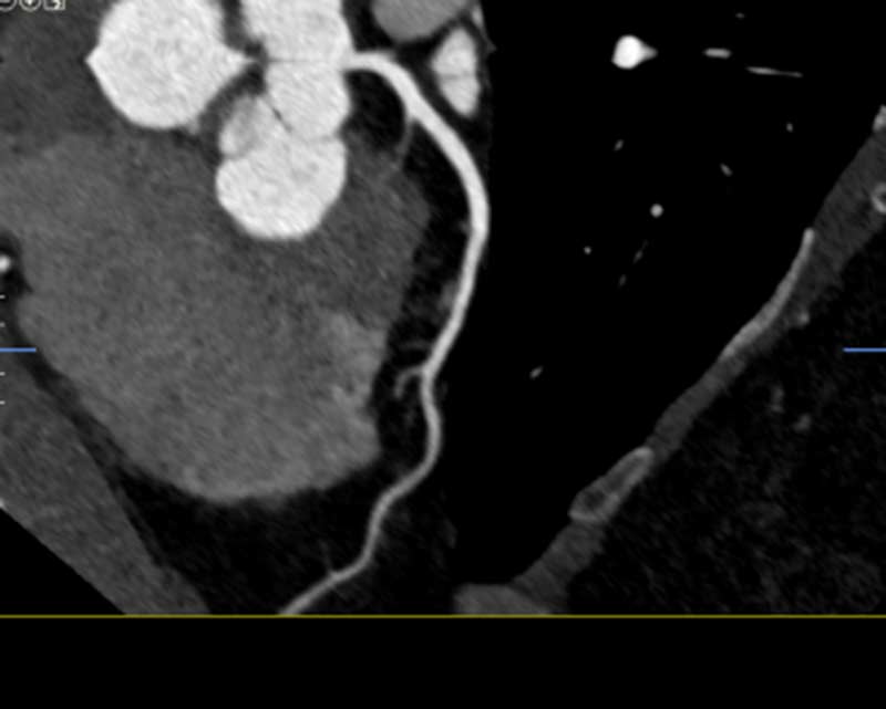 cta coronary examination in fort myers florida