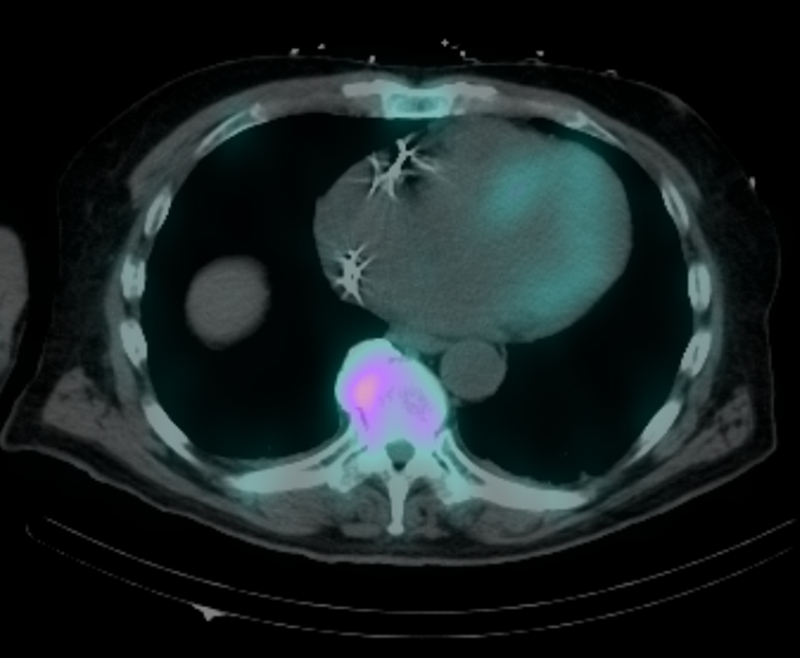 Cardiac amyloid SPECT