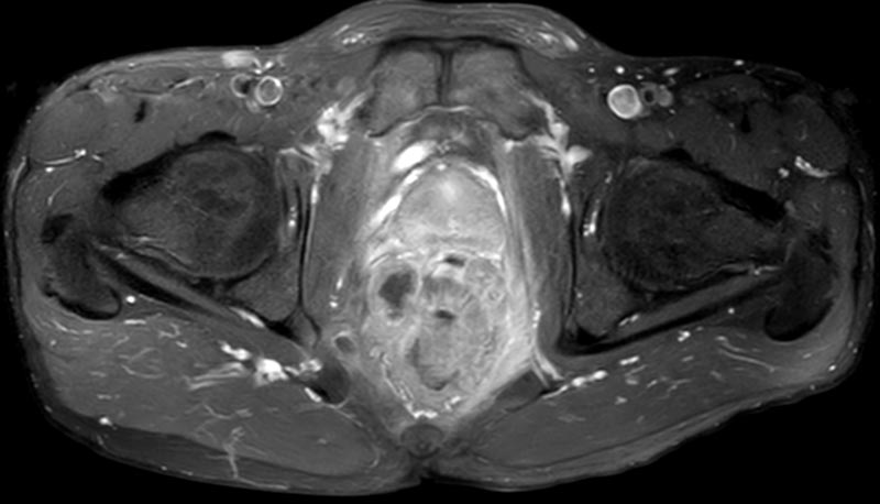 MRI rectal tumor protocol