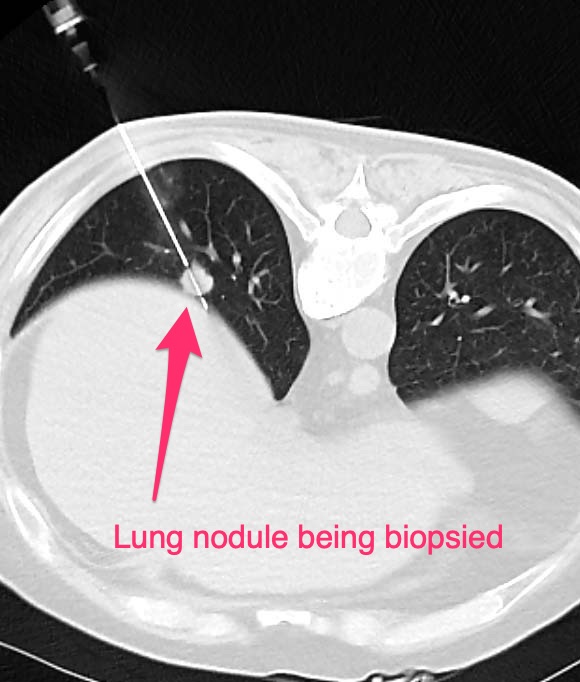 CT Guided Lung Biopsy