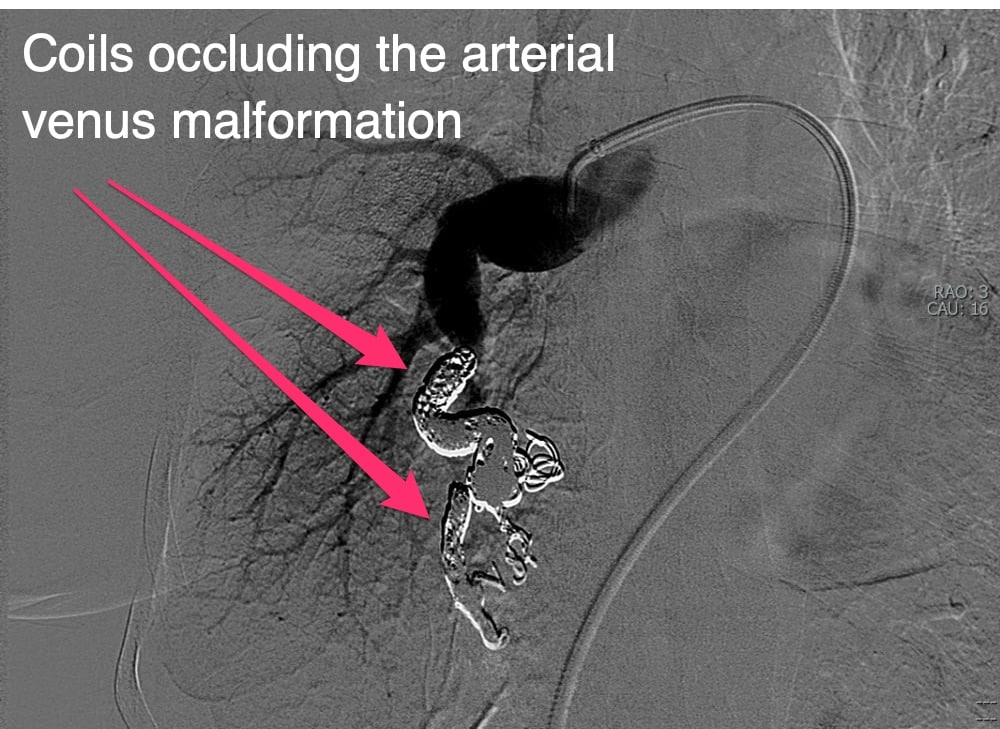 Coils occluding the arterial venus malformation