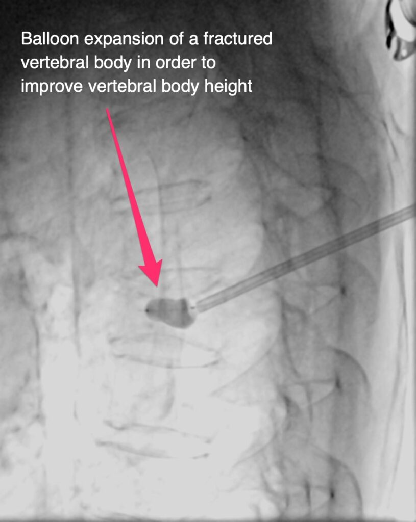 Compression Fracture Treatment - Kyphoplasty - Balloon expansion of a fractured vertebral body in order to improve vertebral body height