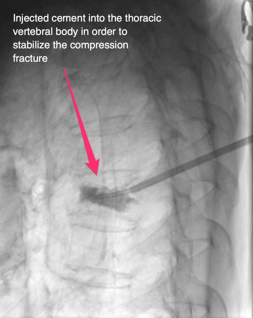 Compression Fracture Treatment - Kyphoplasty - Injected cement into the thoracic vertebral body in order to stabilize the compression fracture