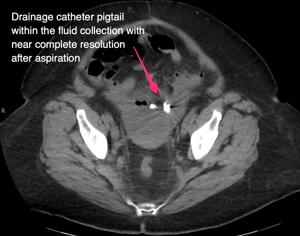 Drainage catheter pigtail within the fluid collection with near complete resolution after aspiration