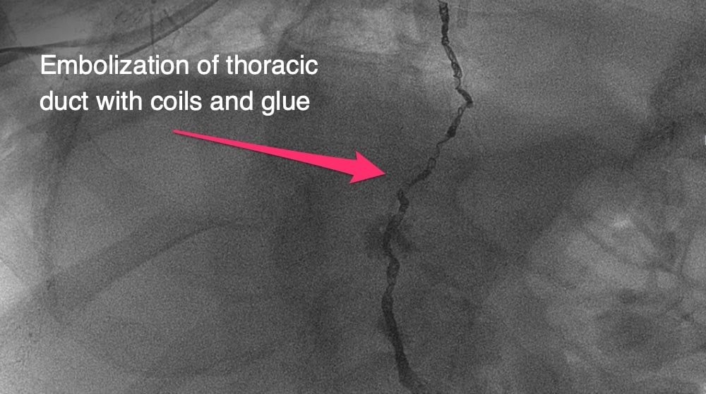 Embolization of thoracic duct with coils and glue