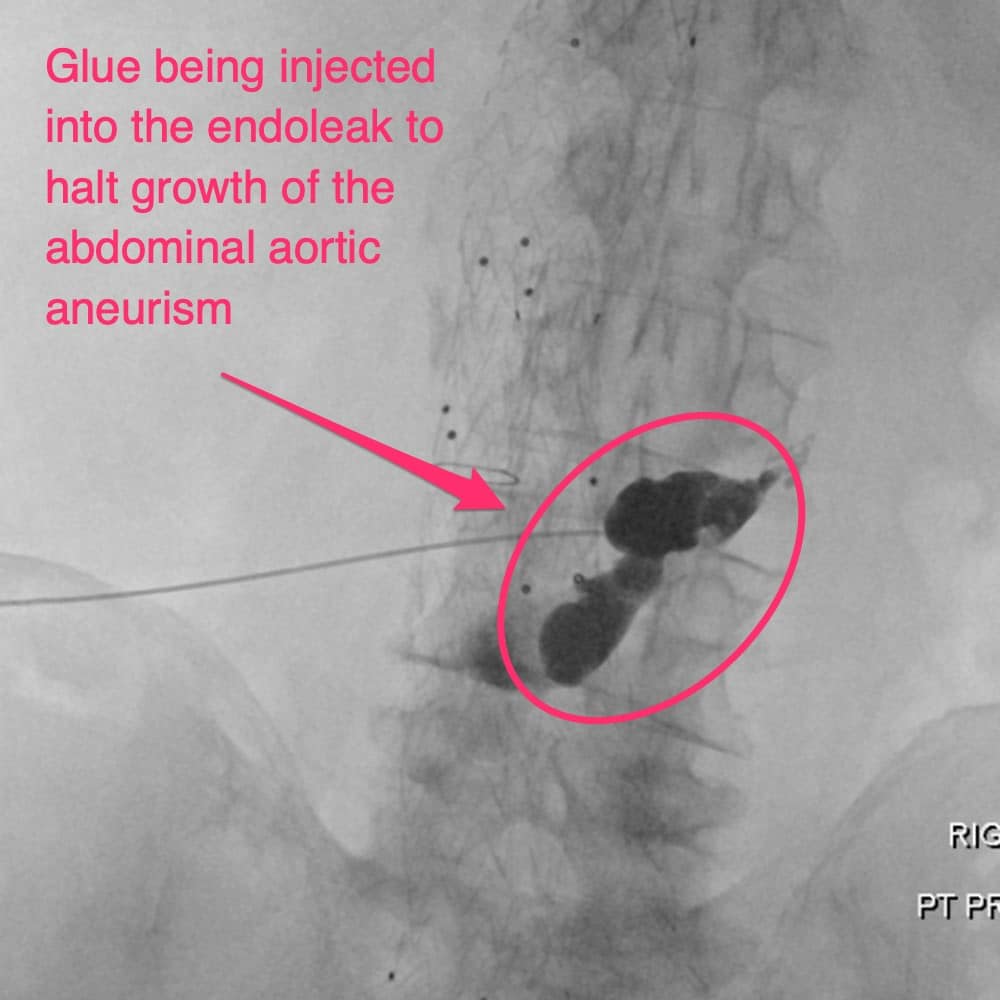 Glue being injected into the endoleak to halt growth of the abdominal aortic aneurism