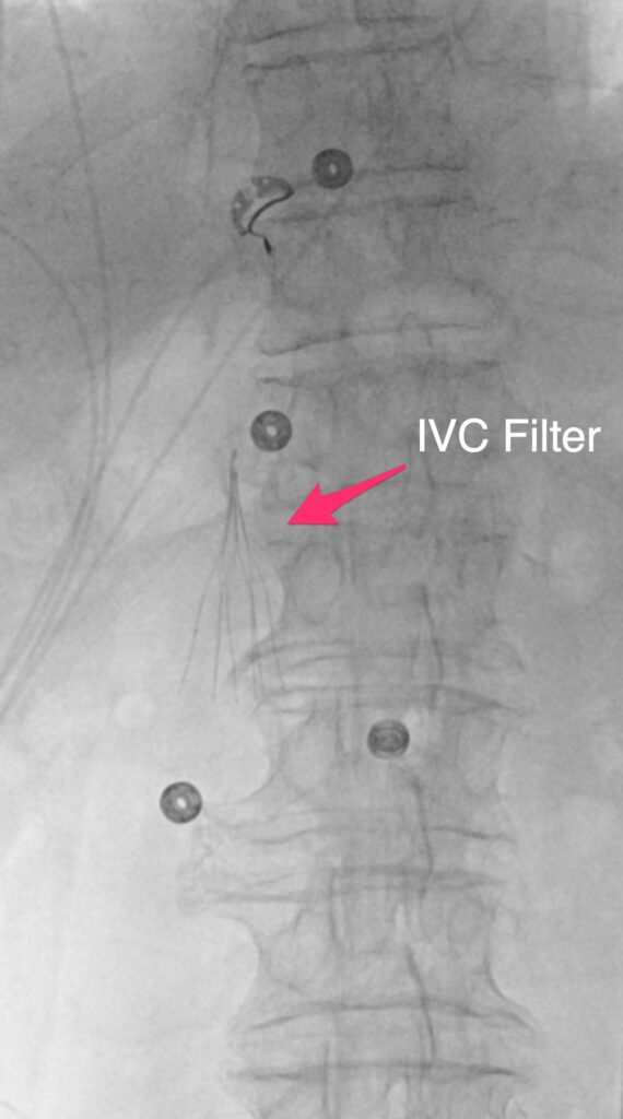 IVC Filter