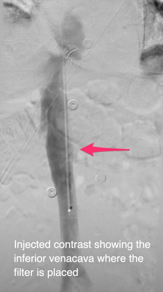 IVC Filter - Injected contrast showing the inferior venacava where the filter is placed