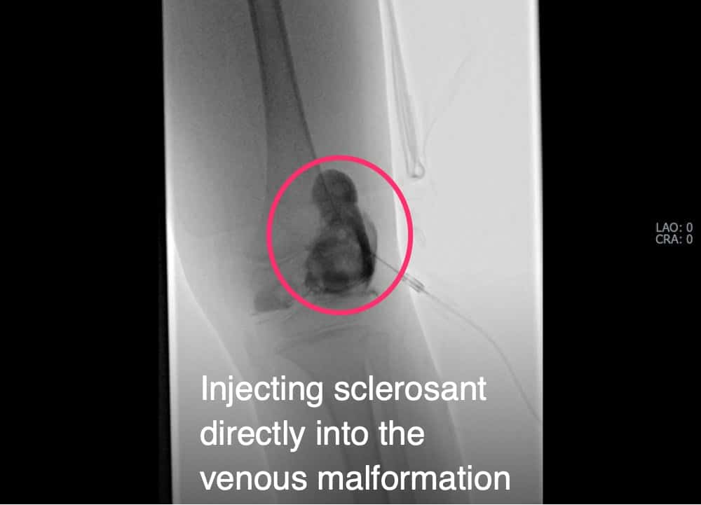 Injecting sclerosant directly into the venous malformation