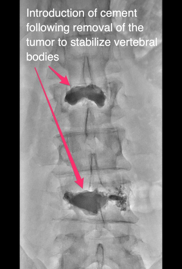 Kyphoplasty - introduction of cement following removal of the tumor to stabilize vertebral bodies