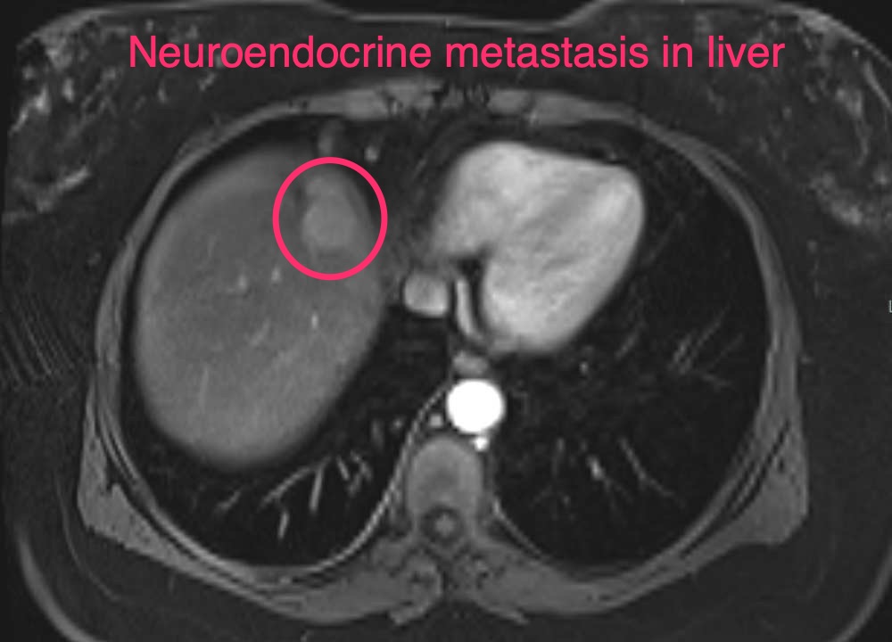 Liver tumore pre Y90 embolization - neuroendocrine metastasis in liver