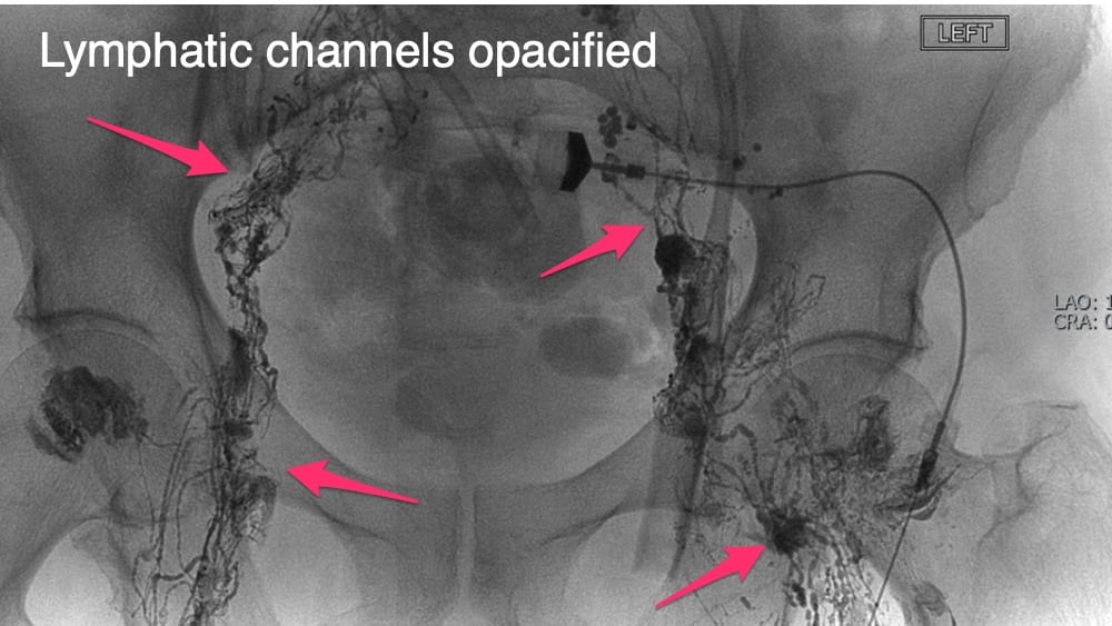 Lymphatic channels opacified