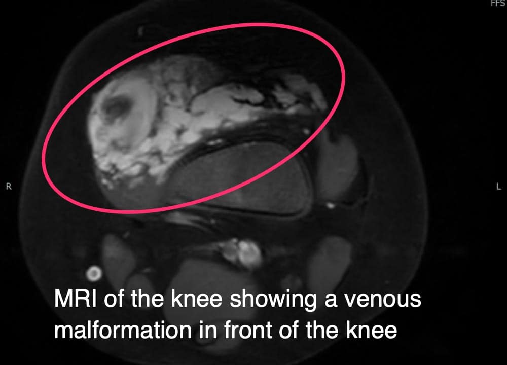 MRI of the Knee Showing a Venus Malformation in front the knee