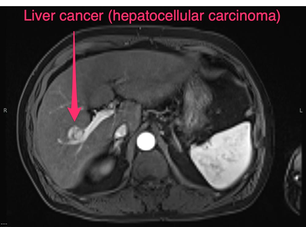 Microwave ablation - Liver cancer (hepatocellular carcinoma)