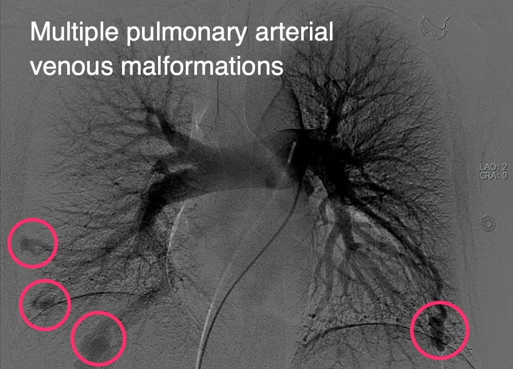 Multiple pulmonary arterial venous malformations