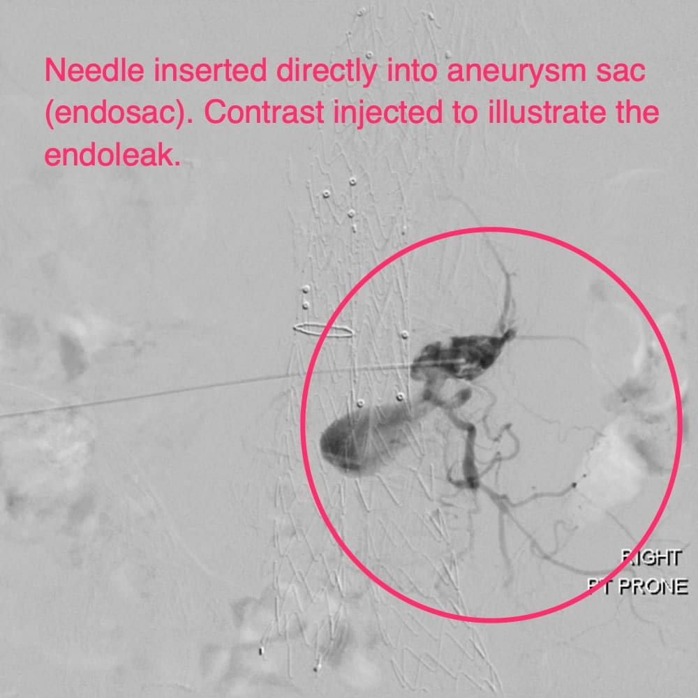 Needle inserted directly into aneurysm sac (endosac), contrast injected to illustrate the endoleak