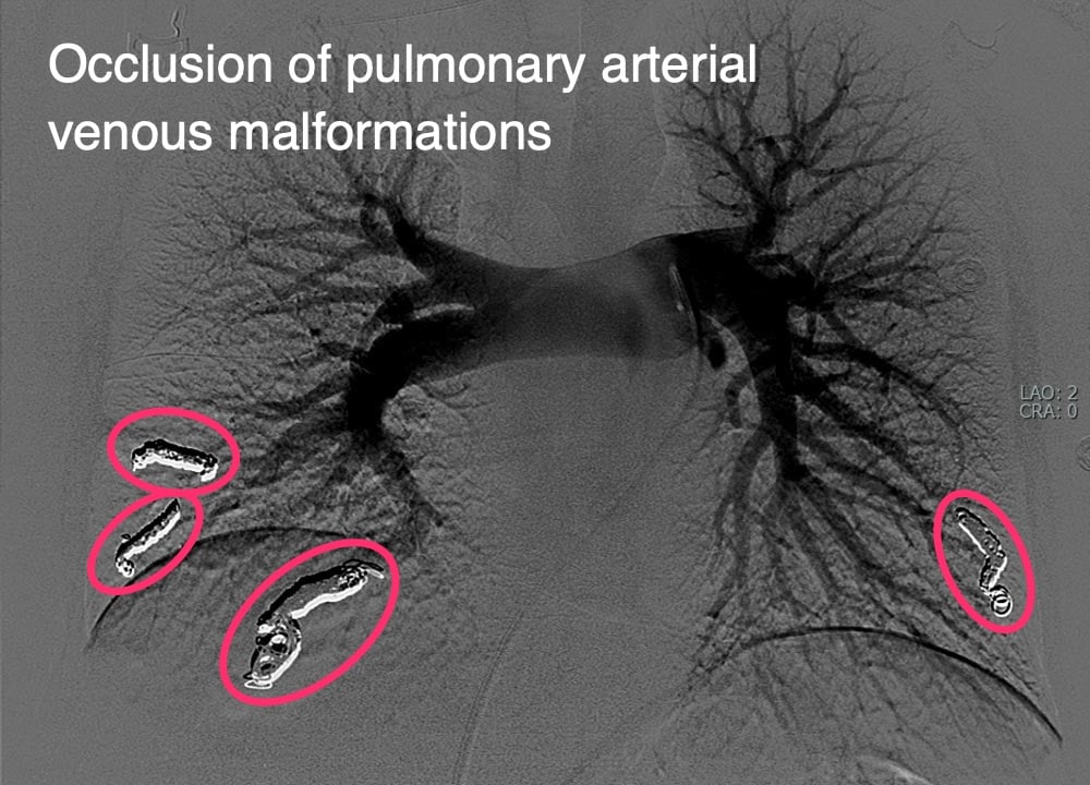 Occlusion of pulmonary arterial venous malformations