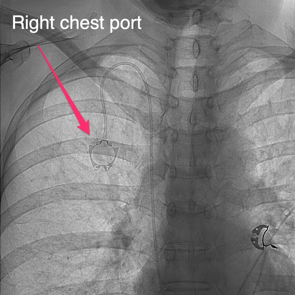 Port placement - right chest port