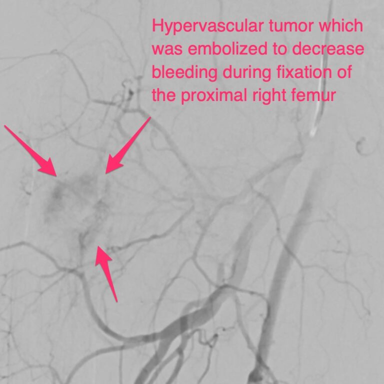Preoperative Embolization and Ablation of Musculoskeletal Tumors