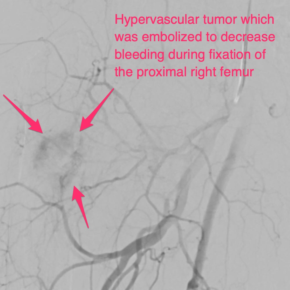 Preop MSK tumor - Hypervascular tumor which was embolized to decrease bleeding during fixation of the proximal right femur