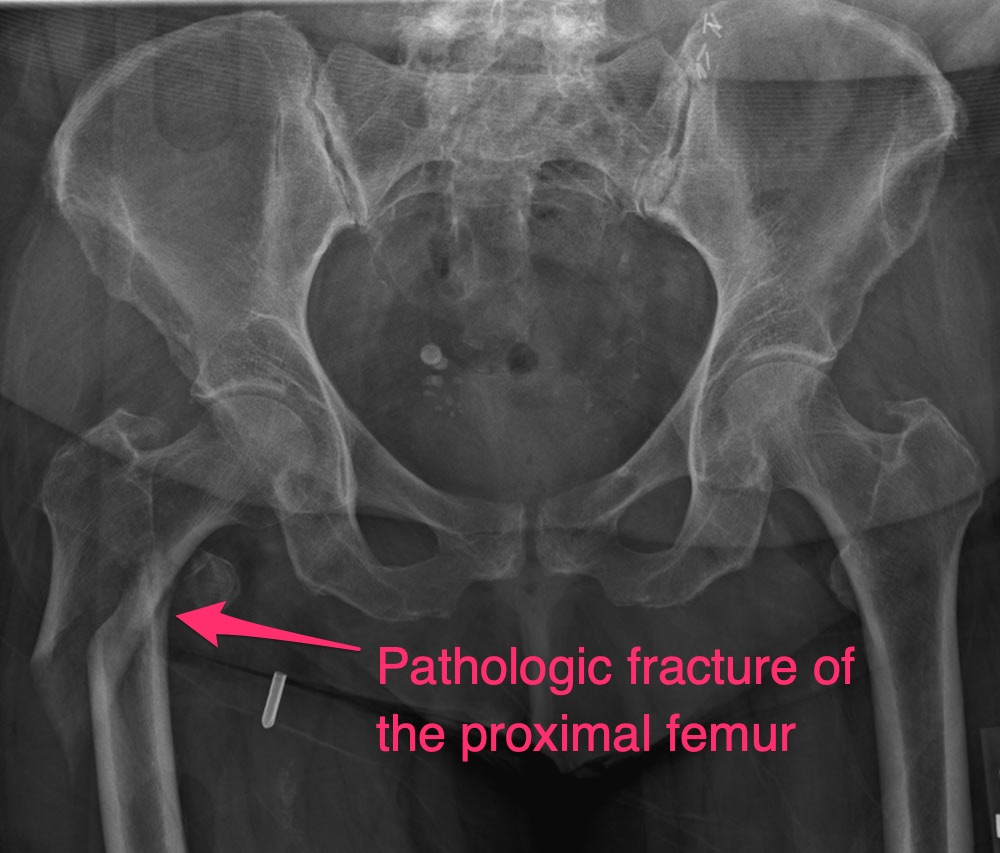 Preoperative MSK Tumor XRay Pathologic fracture of the proximal femur