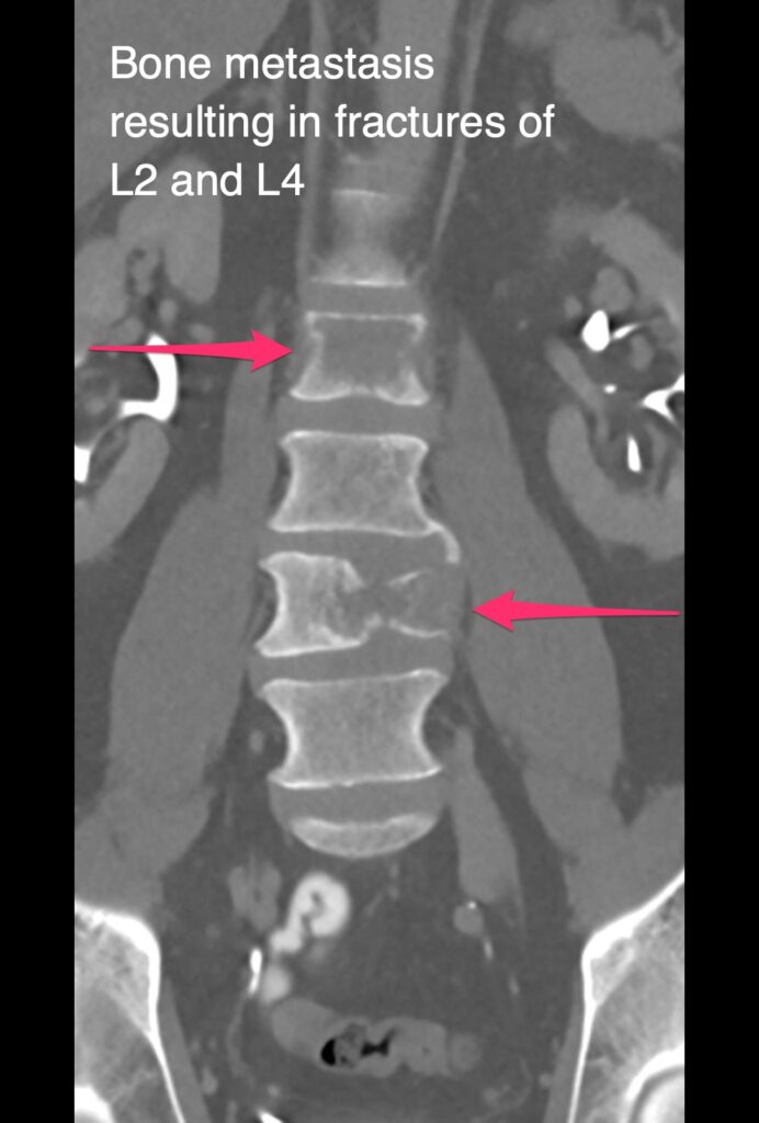 Prevertebral ablation - bone metastasis resulting in fractures of L2 and L4