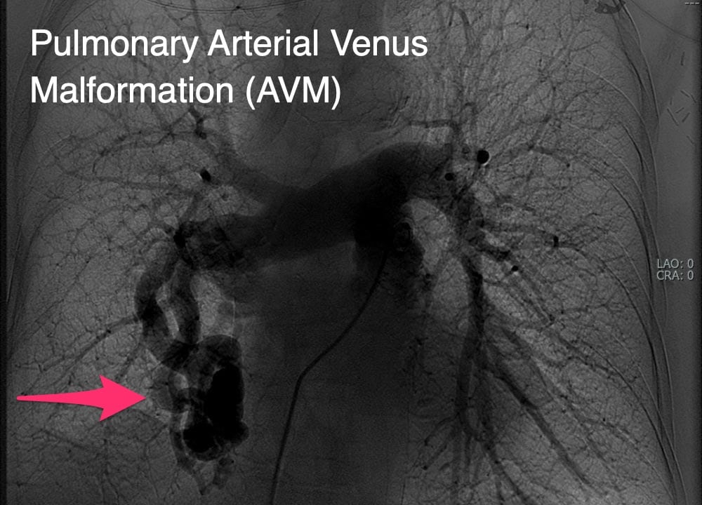 Pulmonary Arterial Venus Malformation (AVM)