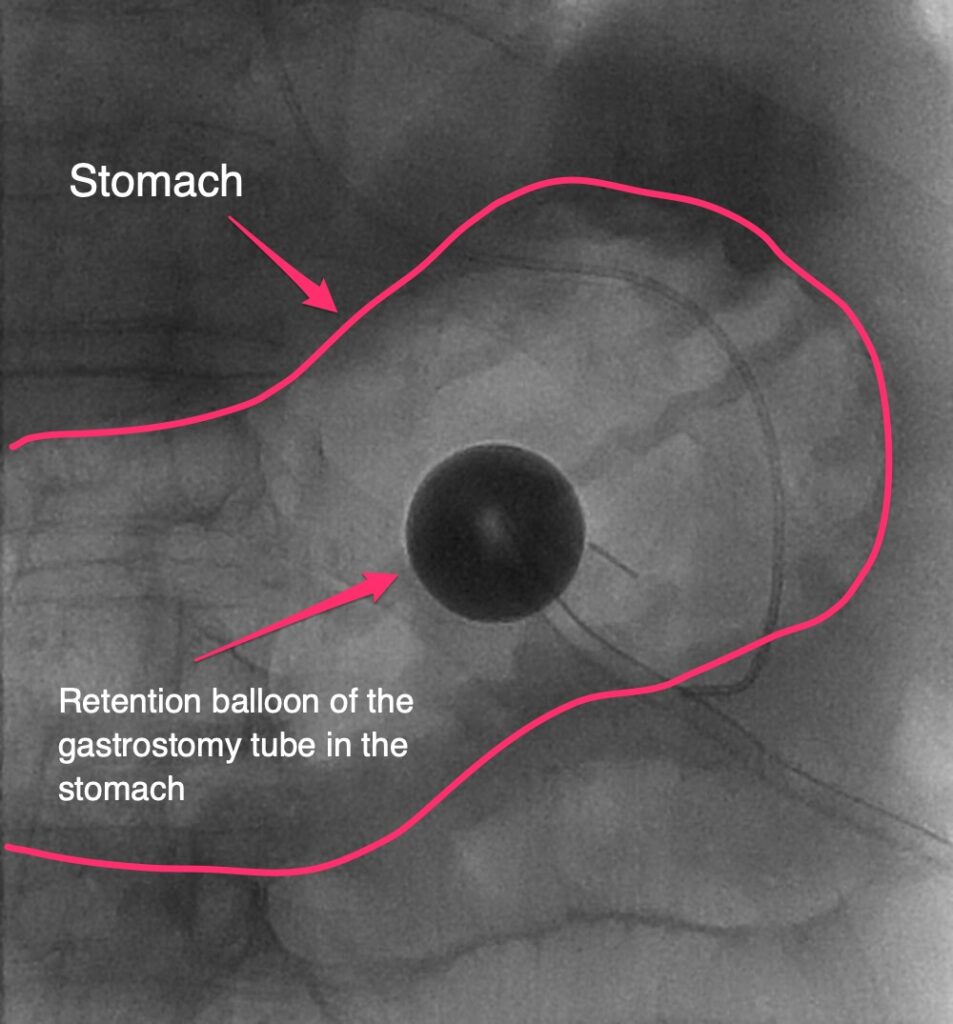 Retention balloon of the gastrostomy tube in the stomach