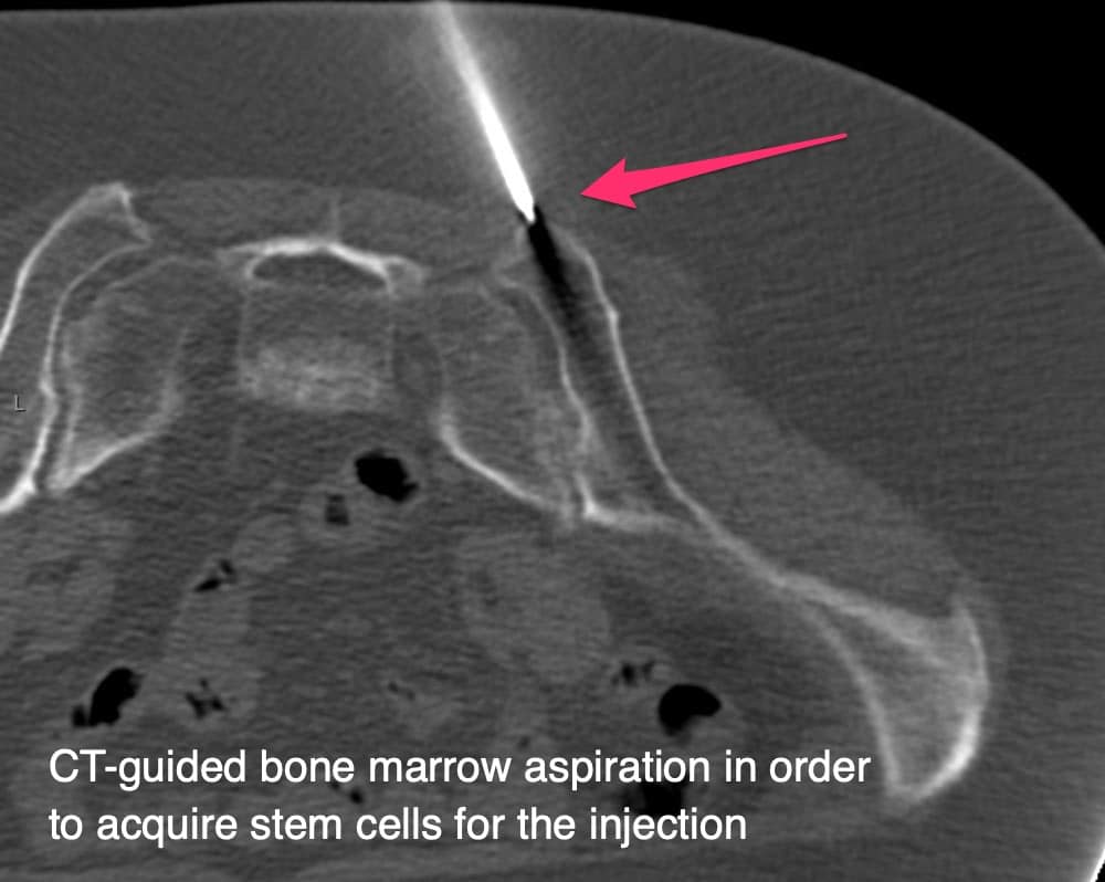 Stem Cell Treatment - CT guided bone marrow aspiration in order to acquire stem cells for injection