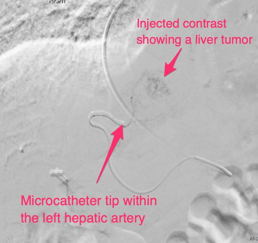 Transarterial Chemoembolization (TACE) Injected Contrast Showing a Liver Tumor & Microcatheter Tip in a Hepatic Artery Branch