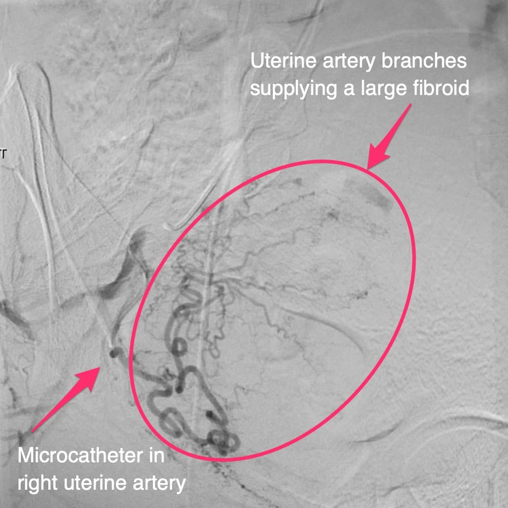 Uterine artery embolization Microcatheter in right uterine artery Uterine artery branches supplying a large fibroid