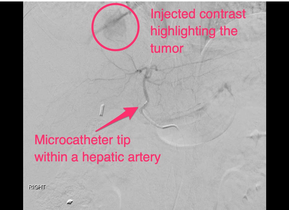 Y90 Embolization Injected Contrast Showing a Liver Tumor & Microcatheter Tip in a Hepatic Artery Branch