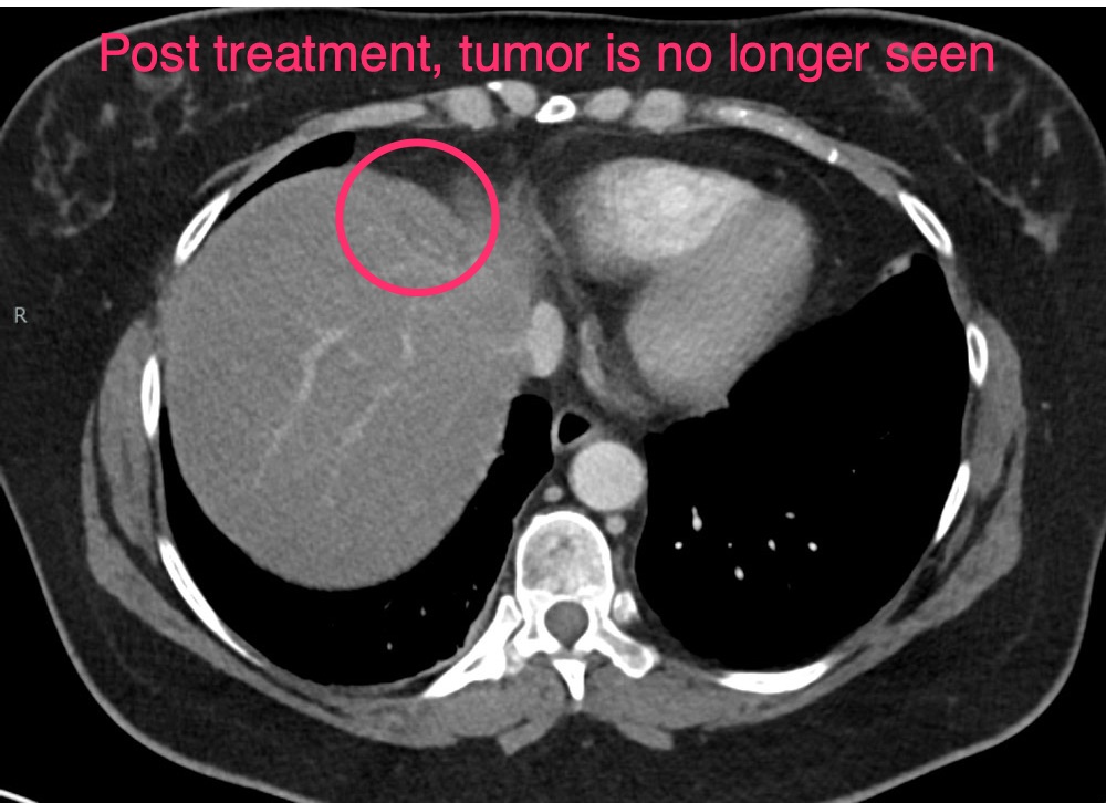 Y90 Embolization - Post treatment - tumor is no longer seen