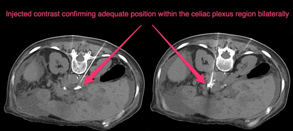 celiac plexus block - upper abdomen - Injected contrast confirming adequate position within the celiac plexus region bilaterally