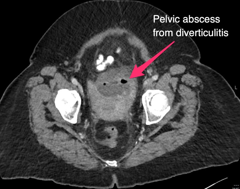 drainage catheter 1 Pelvic abscess from diverticulitis