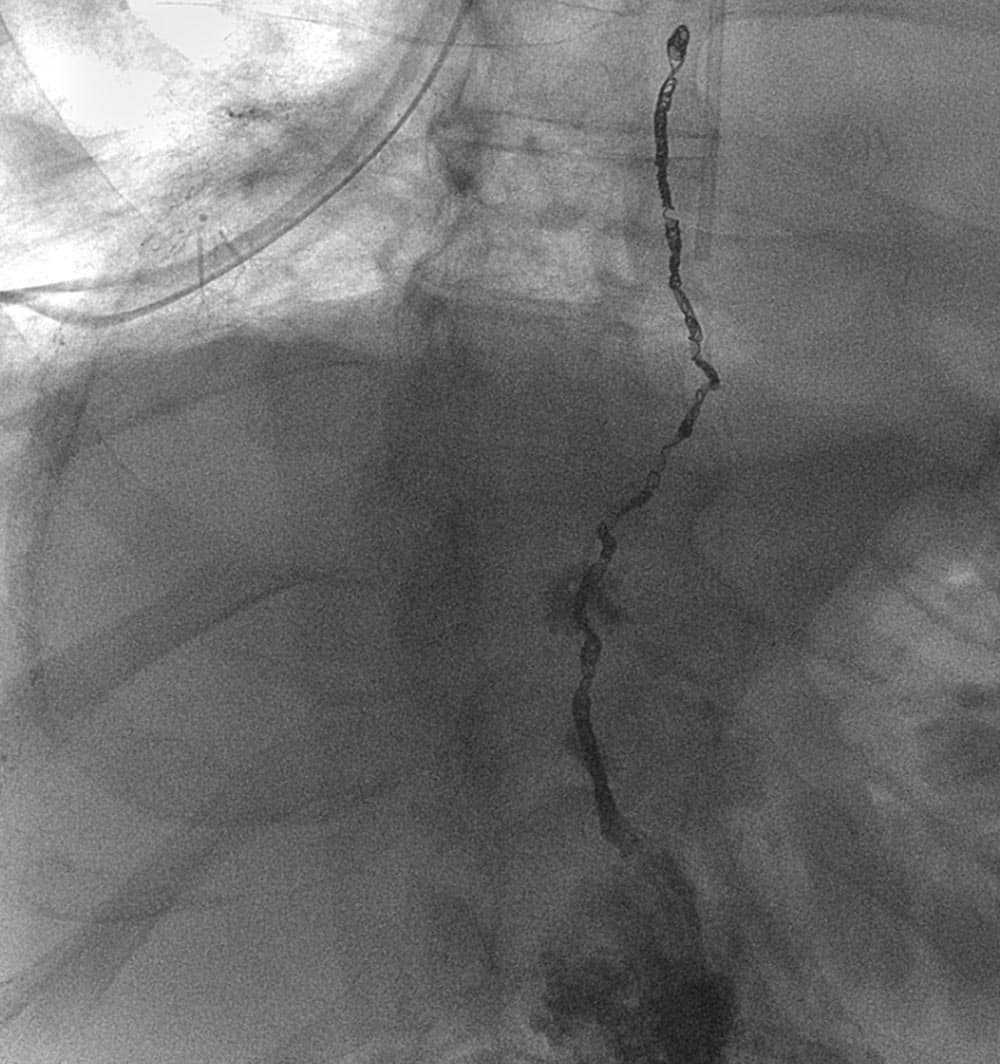 Interventional Radiology - Thoracic Duct Embolization in Fort Myers Florida at Florida Radiology Consultants