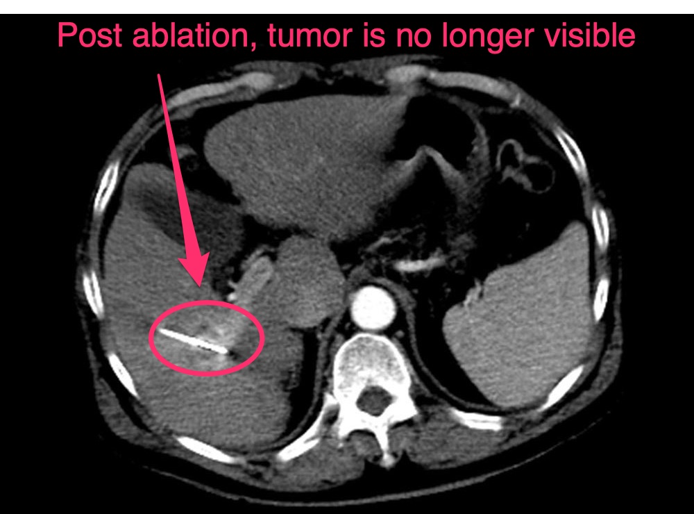 microwave ablation 1-1 of hepatocellular carcinoma hcc post ablation tumor is no longer visible