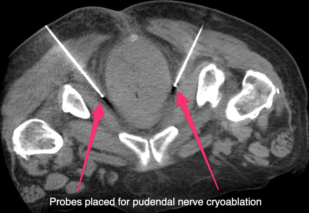 neurolytic blocks probed placed for pudendal nerve cryoablation