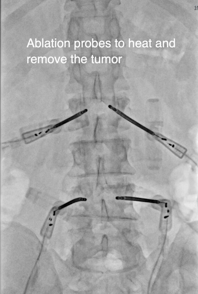 vertebral ablation probes to heat and remove the tumor